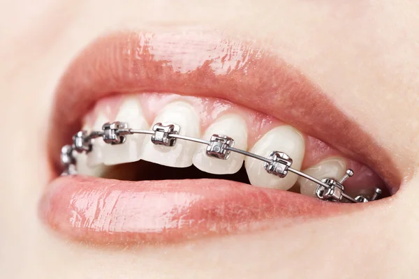 depositphotos 6207772 stock photo teeth with braces